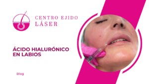 Ácido hialurónico en labios